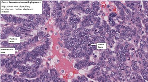 Ovary Serous Carcinoma Serous Cystadenocarcinoma Nus Pathweb