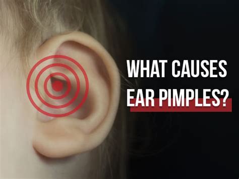 What Causes Ear Pimples And How To Treat It