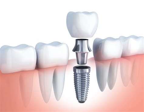 Todo Lo Que Debes Saber Sobre Los Implantes Dentales Cl Nica Dental