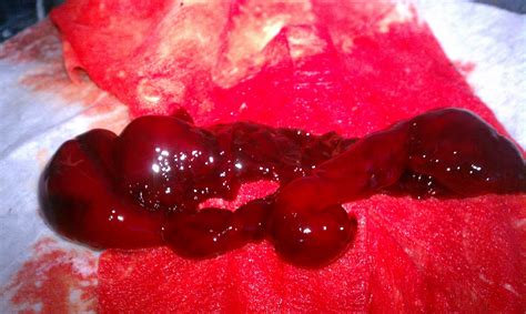 Heavy Blood Clots During Period Amenorrhea Evaluation And Treatment