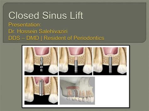 Closed Sinus Lift Surgery