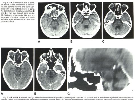 Figure From Evolution Of Central Pontine Myelinolysis On Ct