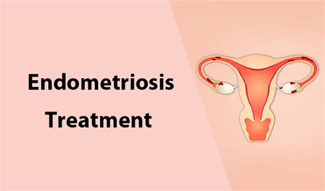 Endometriosis is the abnormal growth of endometrial cells outside the uterus. آیا آندومتریوز درمان دارد؟ | آنا مشاور