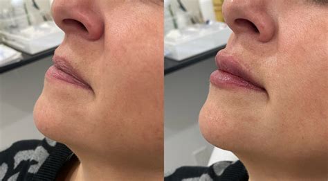 Before After Subtle Lip Filler Inspo Md Beauty Clinic