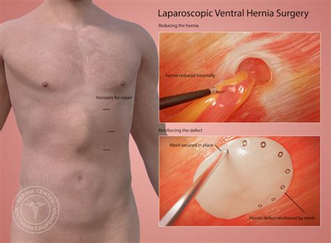 Ventral Hernia Repair Pasadena Orange County CA