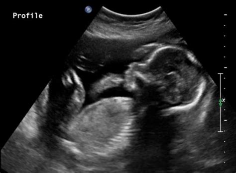 20 Week Ultrasound Boy Or Girl D May 2016