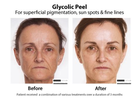 Glycolic Peel Glycolic Acid Skin Renewal