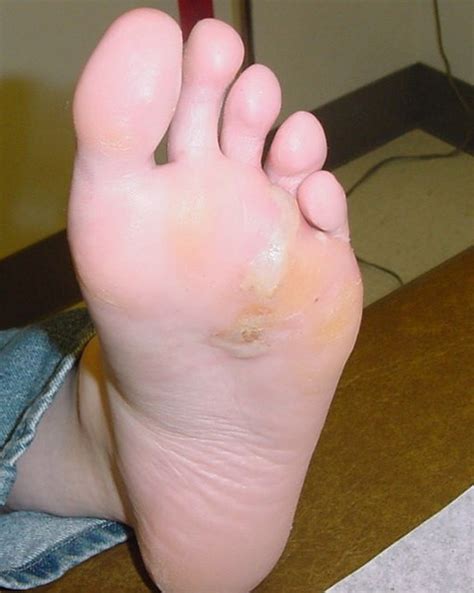 Tinea Pedis Diseases Conditions Minuteconsult