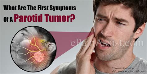 What Are The First Symptoms Of A Parotid Tumor And How Do You Test For It