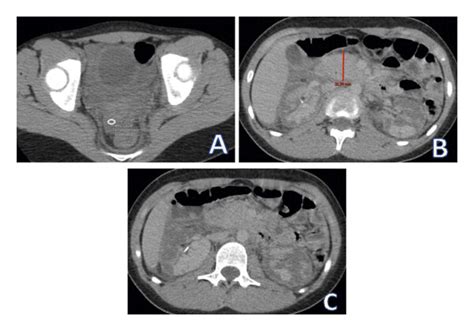 Abdomino Pelvic Ct Scan Performed 12 Hours After Trauma Axial View