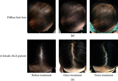 Botox For Hair Do Botox Scalp Injections Promote Hair Growth