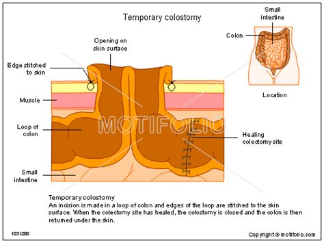 Temporary Colostomy Illustrations