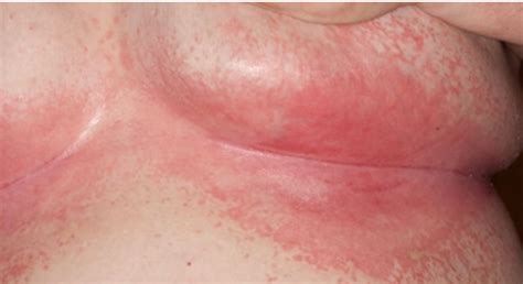 Common Acute Rashes In Urgent Care Setting Medical Care 1