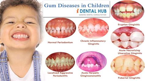 Gum And Periodontal Diseases Can Occur In Children Various Gum