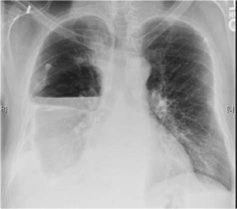 Maybe you would like to learn more about one of these? Pneumothorax Ex-vacuo or "trapped lung" in the setting of ...