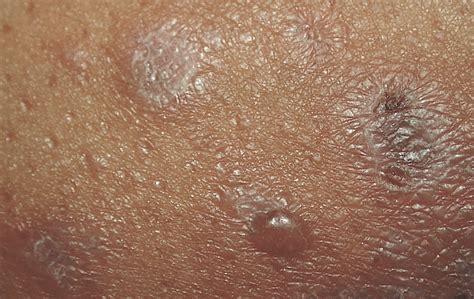 Vesicles In A Patient With A Lichenoid Eruption—quiz Case Dermatology