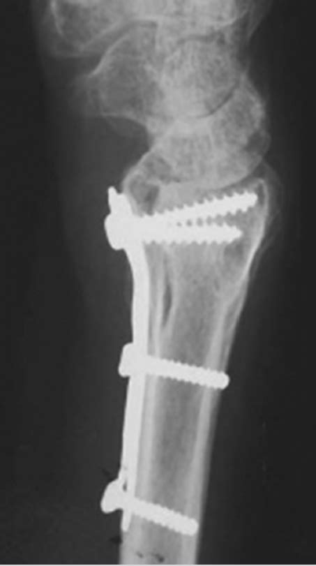 53 Distal Radius Osteotomy For Malunion Dorsal Approach Plastic