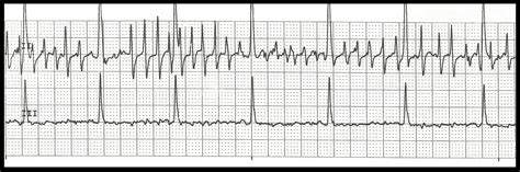 This video explains how to interpret ekg strips and how to tell the difference between a. Float Nurse: Practice EKG Rhythm Strips 164