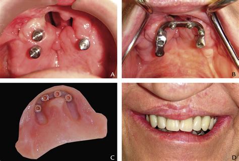Zygomatic Implant Supported Prosthodontic Rehabilitation Of Edentulous