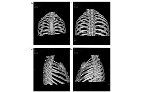 Preoperative Chest Computed Tomographic Reconstruction Revealed A Mass