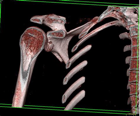 Glenoid Fracture Musculoskeletal Case Studies Ctisus Ct Scanning