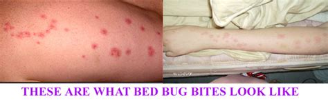 Security Bed Bug Controlbest Bed Bugs Treatment Bedbug Ma