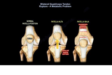Bilateral Quadriceps Tendon Rupture Orthopaedicprinciples Com