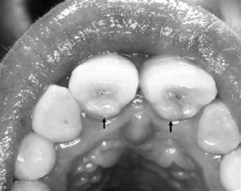 Upper Tooth Drift Related To A Palatal Tooth Bump Dens In Dente Forma