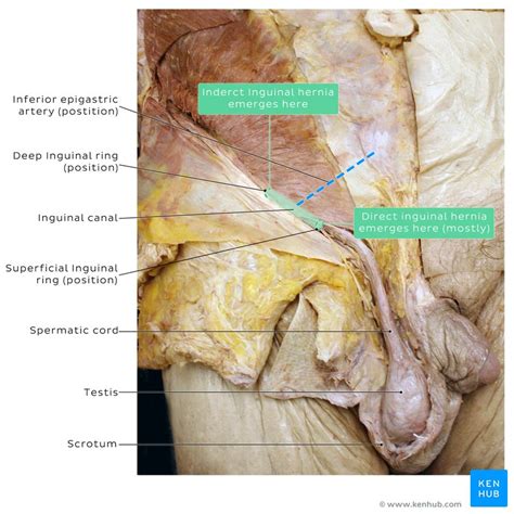 A Case Of A Giant Inguinal Hernia Anatomy And Images Kenhub