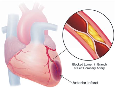 Reversible Myocardial Ischaemia Archives Natural Health News