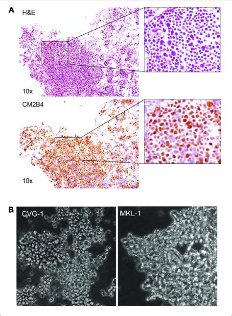 Establishment Of The Merkel Cell Polyomavirus Mcv Positive Cvg 1