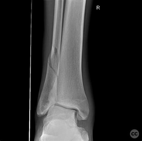Pronation Abduction Pab Weber C Herscovici B Bimalleolar Ankle Fracture