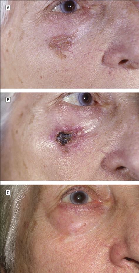 Fifty Five Basal Cell Carcinomas Treated With Topical Imiquimod