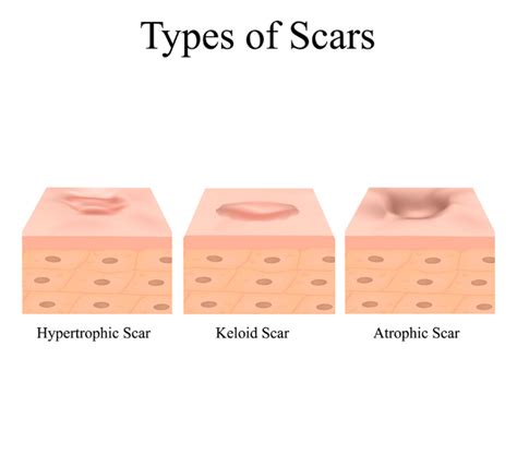 Scars Explained Definition Types Treatments Cell18