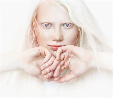 Albinizm Bielactwo Wrodzone Przyczyny Rodzaje Objawy The Best Porn