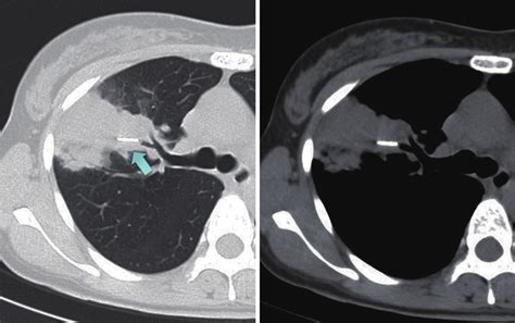 Chest Ct Scans Showed A Foreign Body In The Right B3a Arrow With A