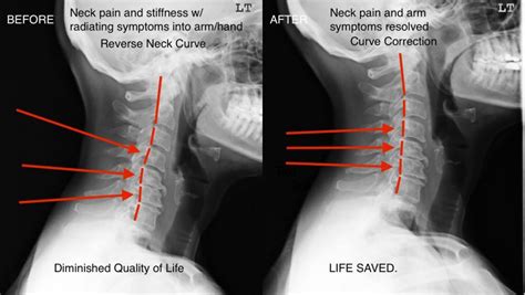 Chiropractic Adjustment Before And After