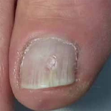 Superficial Onychomycosis Due To Infection With Trichophyton Download