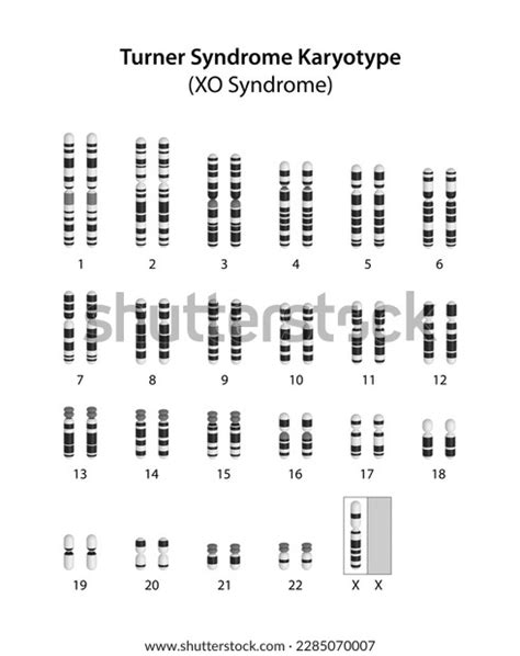 Turner Syndrome X Human Karyotype Stock Illustration