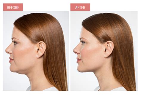 Kybella A Solution For Submental Fat Aka The Double Chin Rejuvime
