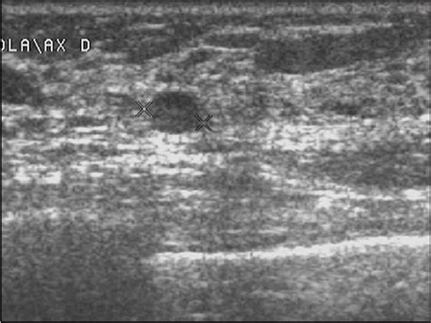 Sonographic Findings Of Additional Malignant Lesions In Breast