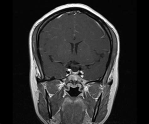 Pituitary Microadenoma Image