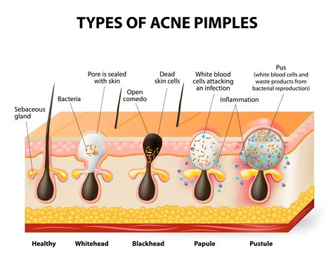 Types Of Acne Acne Prone Skin Care