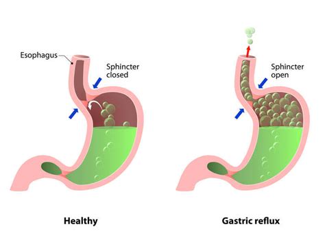 What Are Some Acid Reflux Trigger Foods To Avoid Nucific