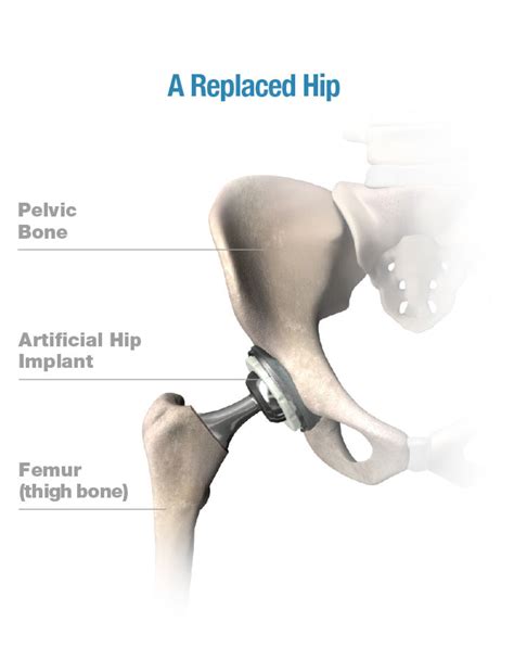 Hip Procedures Stryker Orthopaedics Uk