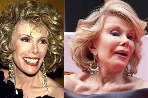 Joan Rivers C L Brit S Avec Mauvaise Chirurgie Plastique