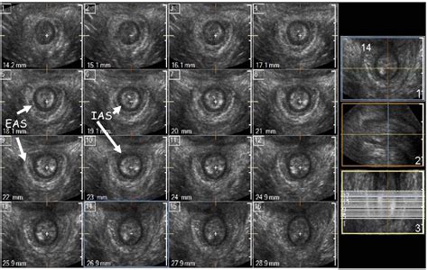 Figure 1 From Transperineal Three Dimensional Ultrasound Imaging For
