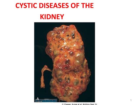 Ppt Cystic Diseases Of The Kidney Powerpoint Presentation Free
