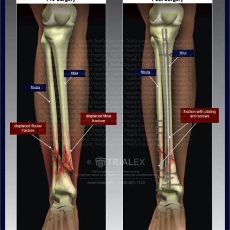 Tibial And Fibular Fracture Trialexhibits Inc