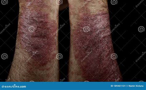 Psoriasis Eczema On The Arm Man Itching Skin Psoriasis On Black